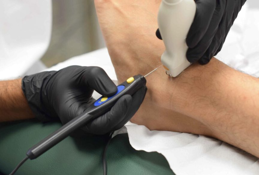 Fisioterapeuta aplicando Electrólisis Percutánea Intratisular (EPI) ecoguiada en el tobillo en On Fisioterapia Fisioterapeuta aplicando Electrólisis Percutánea Intratisular (EPI) ecoguiada en el tobillo en On Fisioterapia